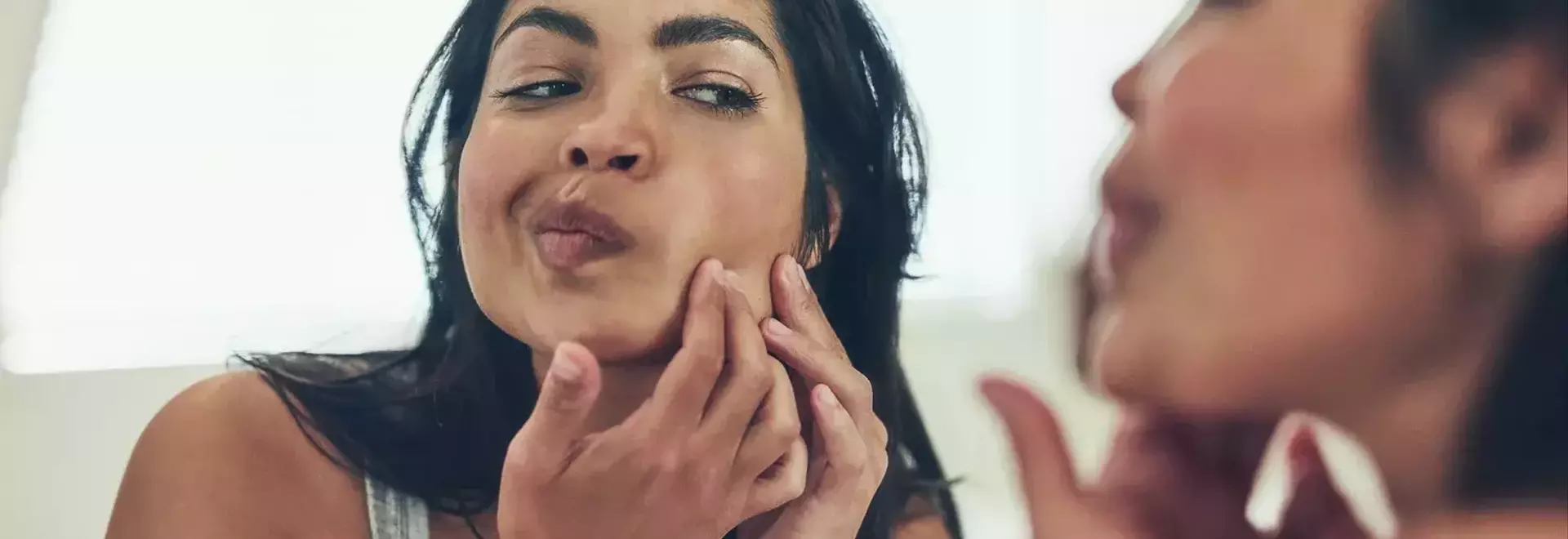Understanding and Managing Postpartum Acne