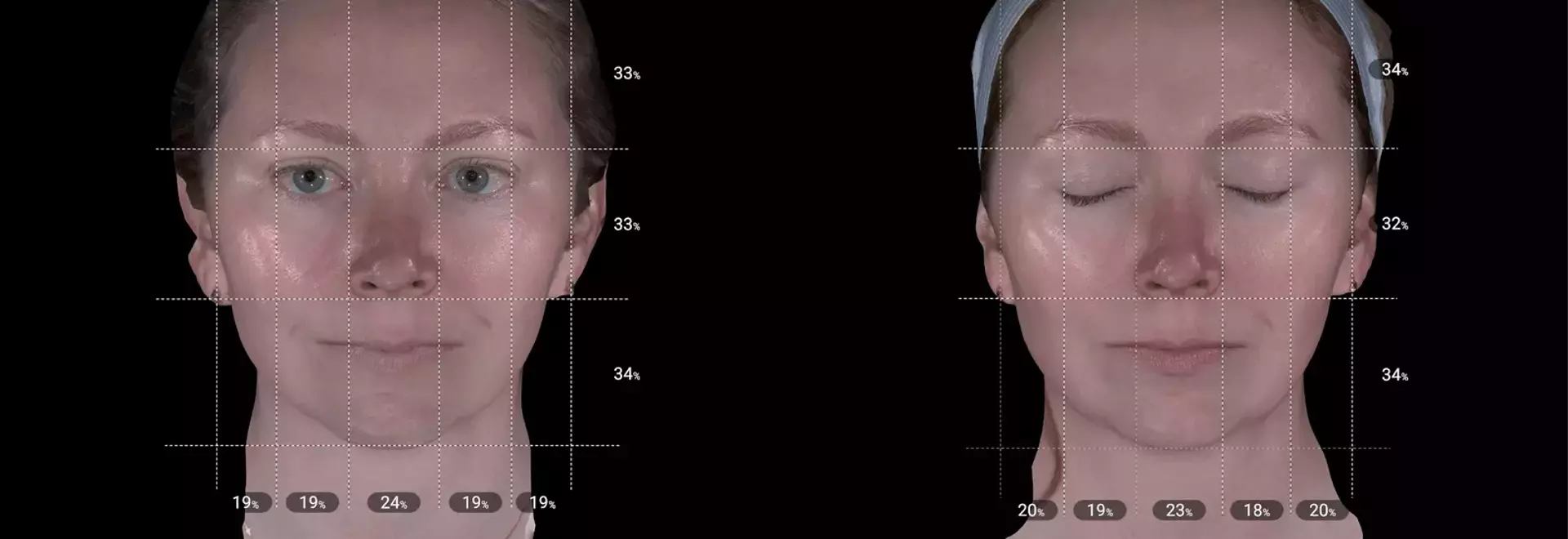 Aesthetic Enhancement: Exploring the Efficacy of XERF for Pre-Wedding Skin Rejuvenation