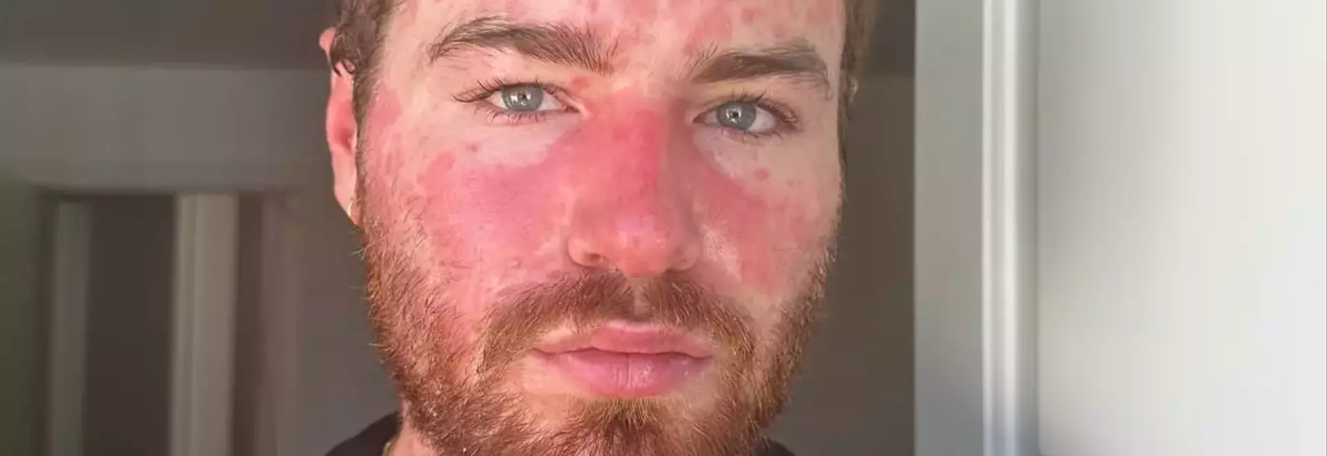 Exercising with Psoriasis: Embracing Activity and Self-Care